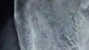 El paciente acudió con dolor porque se había insertado un cable por el pene.