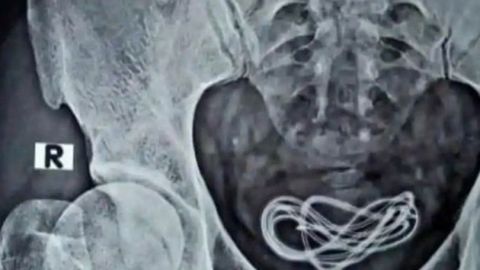 El paciente acudió con dolor porque se había insertado un cable por el pene.