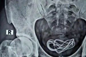 Hombre metió el cargador de su celular dentro de su pene y mintió a los doctores