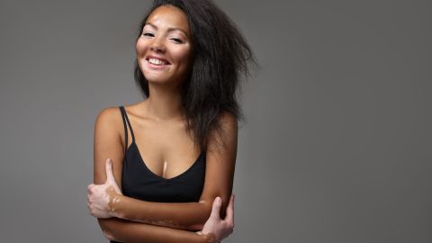 vitiligo