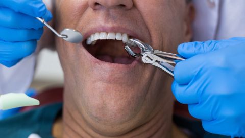Desarrolló una terrible infección sin que lo supiera.