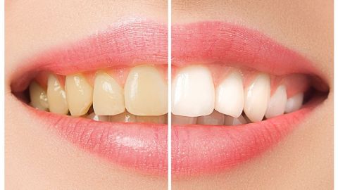 blanqueamiento dientes