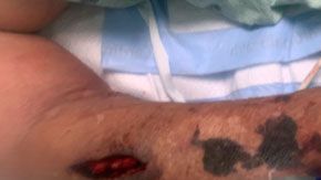 Los médicos dicen que con este hallazgo pueden ser más agresivos para tratar el coronavirus.