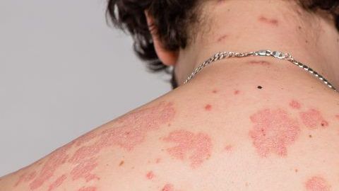 psoriasis