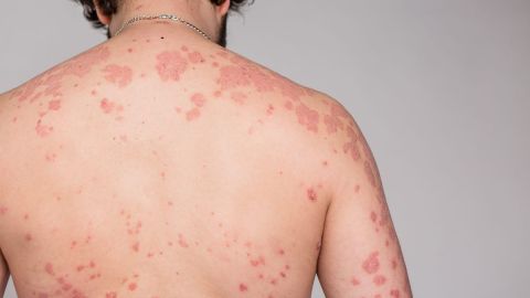 psoriasis