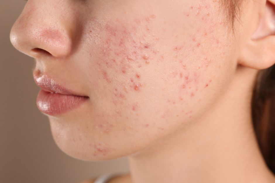 Cómo tratar correctamente los quistes sebáceos de acné en casa