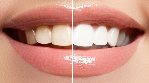dientes blancos