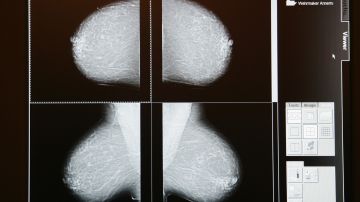 Imagen ilustrativa de una mamografía.