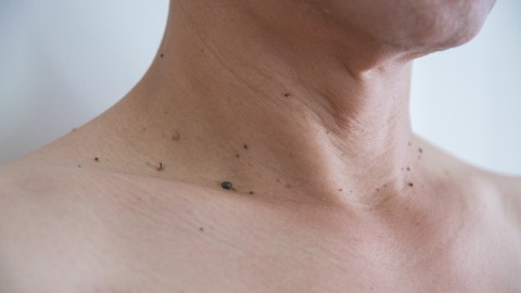 Verrugas