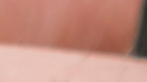 El menor pasó 3 meses con el cable en la uretra.