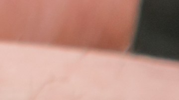 El menor pasó 3 meses con el cable en la uretra.