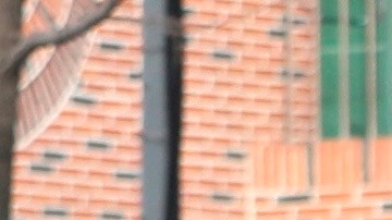 Los doctores pensaron que tenía herpes zóster.