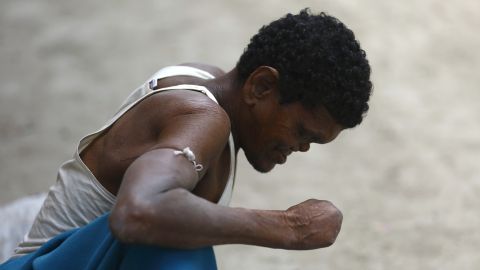 Un hombre con lepra en Nepal.