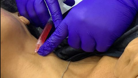 El PRF es una técnica innovadora que se usa en odontología para regenerar tejidos./EDLP