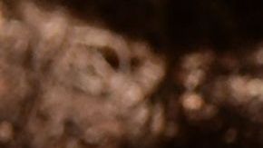 Tuberculosis en India