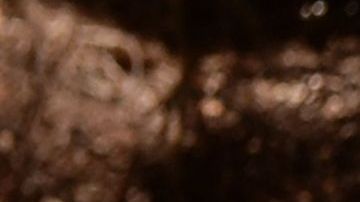 Tuberculosis en India