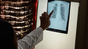 Tuberculosis en India