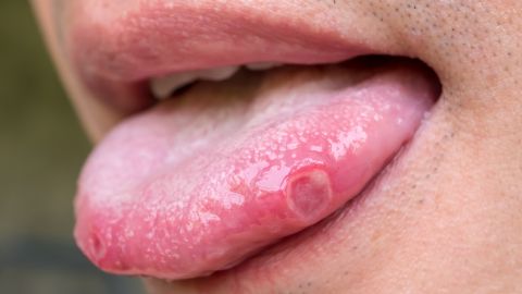 ampollas en la lengua