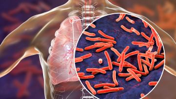 CDC y FDA investigan extraño brote de tuberculosis por posible medicamento contaminado