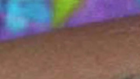 Una persona con lesiones cutáneas producto de la viruela del mono.