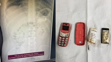 FOTOS: Se tragó un teléfono Nokia 3310 y requirió cirugía para extraerlo