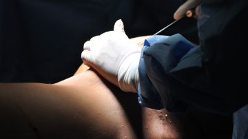 Muere liposucción clínica Monterrey