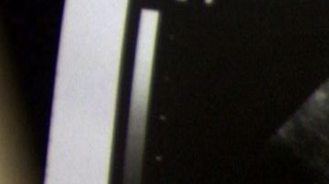 Ultrasonido