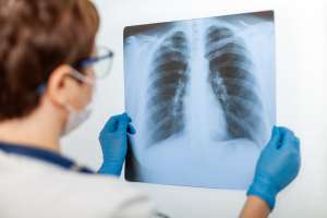 Las imágenes que muestran el daño pulmonar causado por Covid entre personas que sí y que no están vacunadas