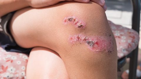 Muerte niña raspadura rodilla