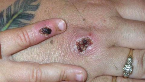 Síntomas de uno de los primeros casos conocidos del virus de la viruela del mono.