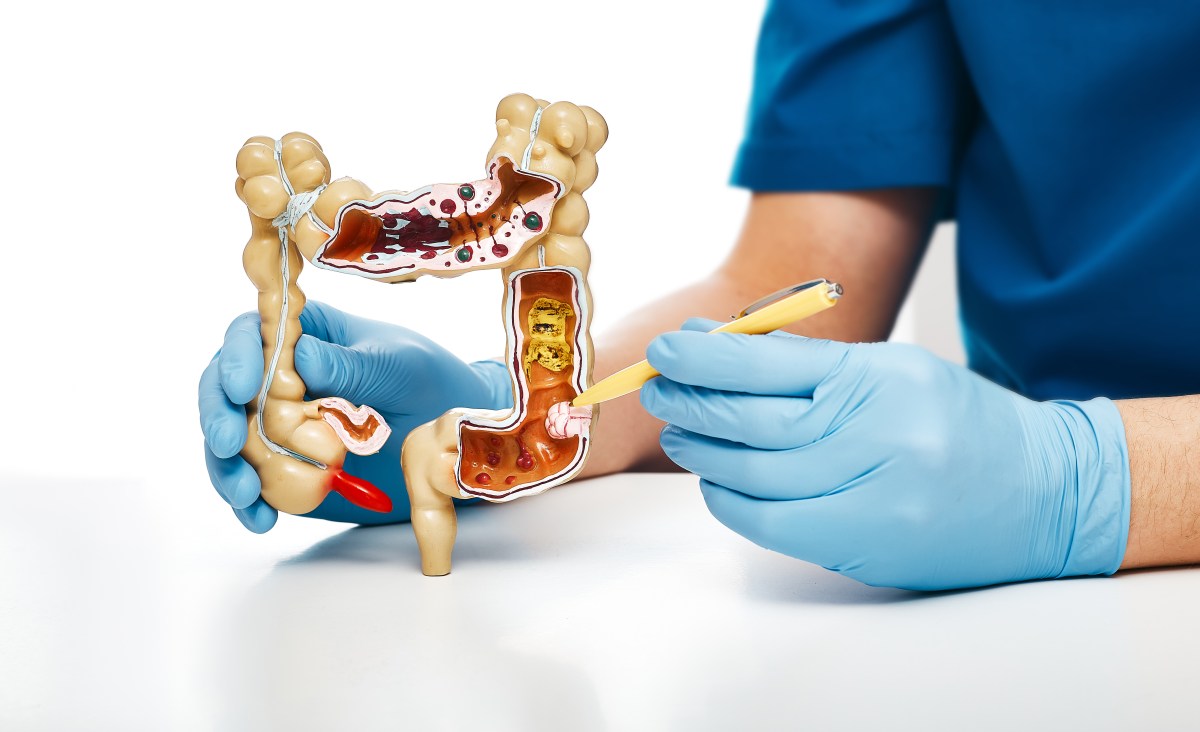 Científicos de la UPR en Puerto Rico encuentran proteína que detecta cáncer colorrectal con 70 % de precisión