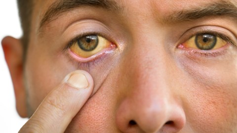 Hepatitis ictericia