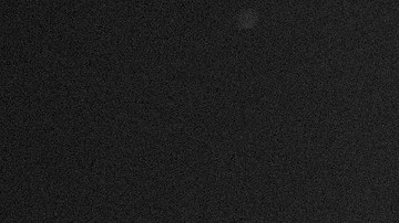 La niña de 11 años tuvo que ser intervenida en el hospital.