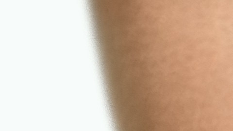 Periodontitis