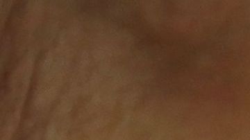 Departamento de Salud de Nueva York condado de Rockland Condado de Orange Poliomielitis