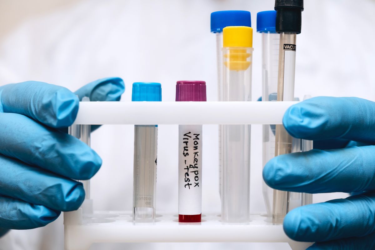 Vacuna, prevención y PCR, claves para contener la viruela del mono