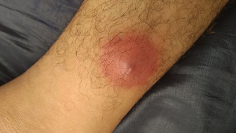 Inflamación