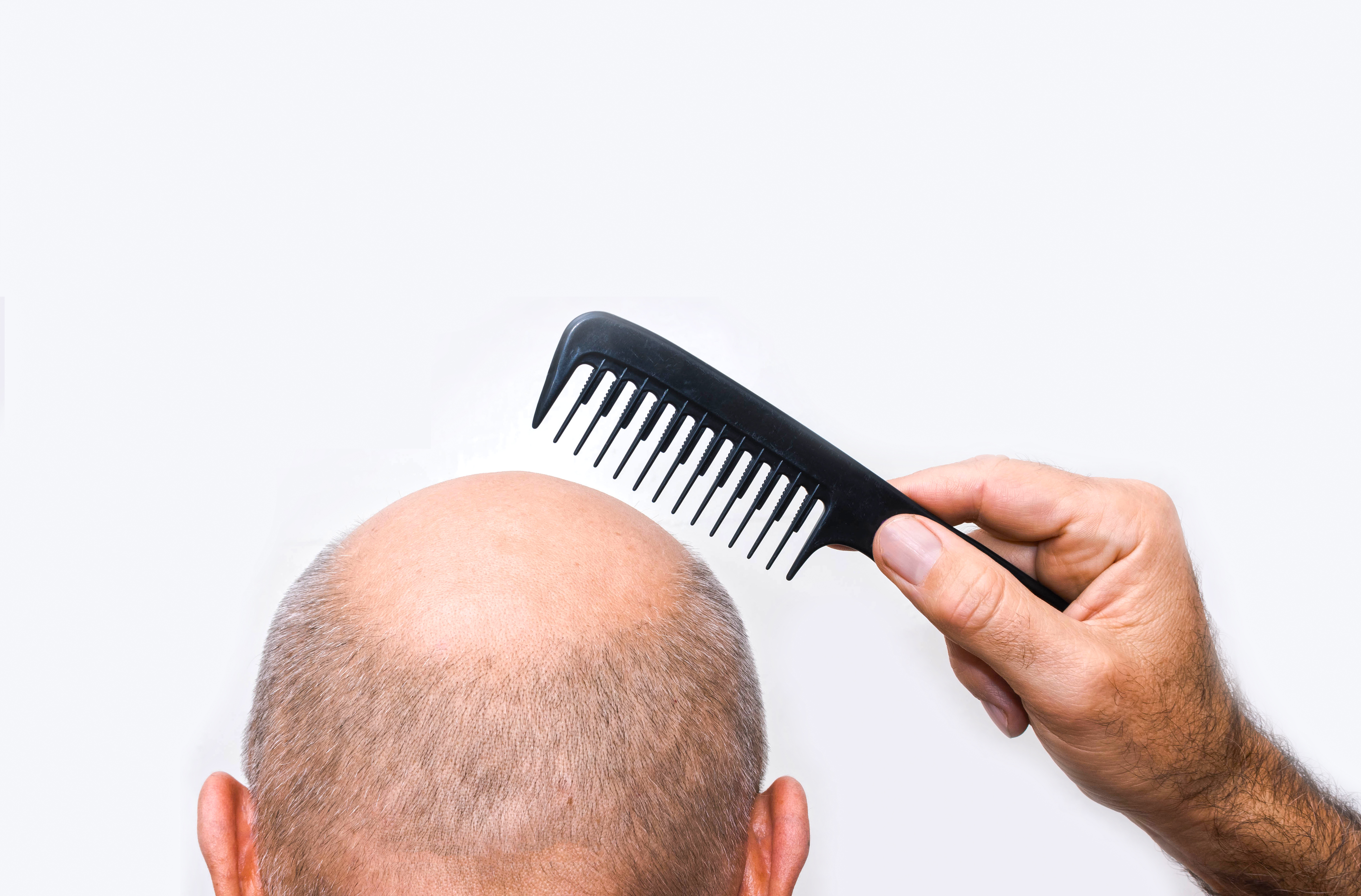 3 persistent myths about baldness, according to an expert from the University of California