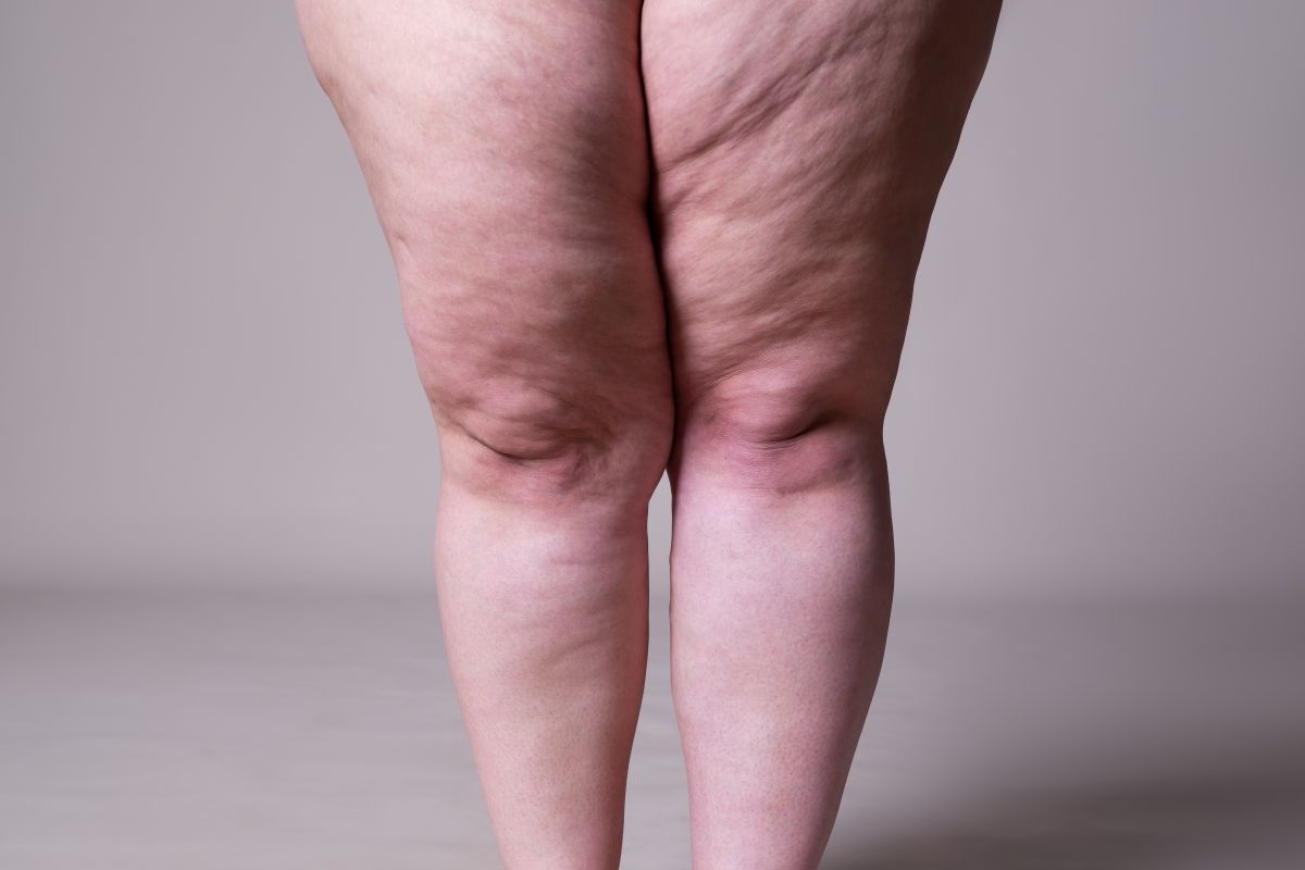 Cómo Diferenciar La Lipedema De La Obesidad El Diario Ny