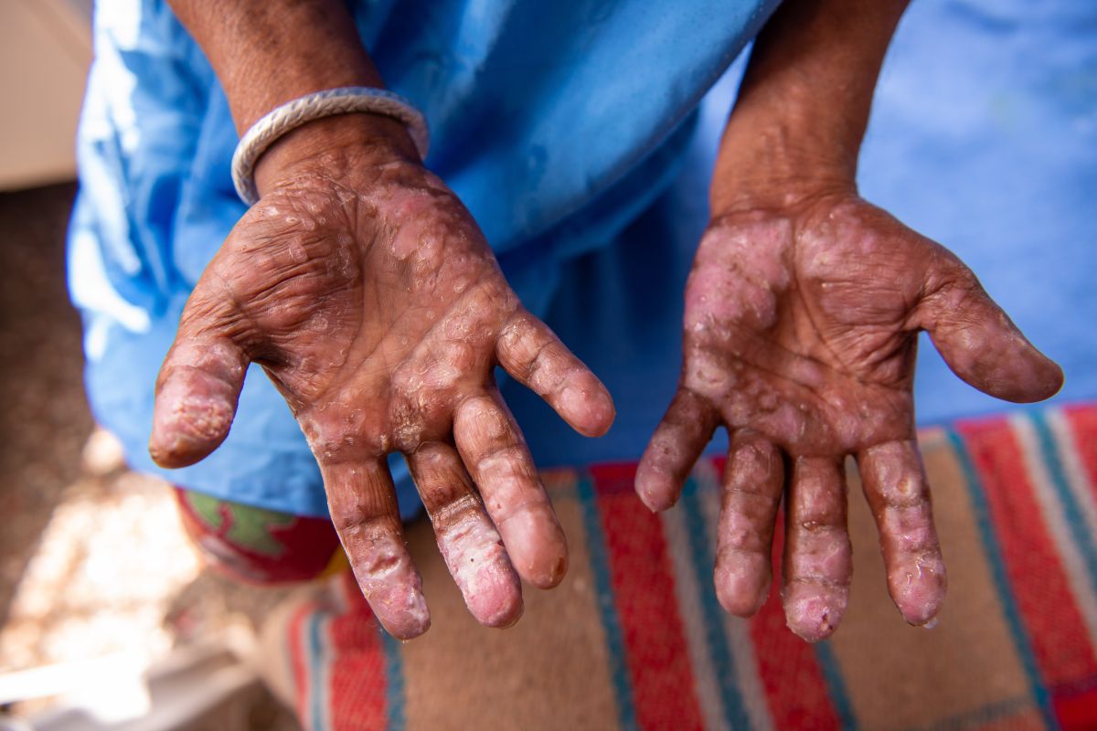 Contrario a lo que se cree, la lepra no es una enfermedad sumamente contagiosa.