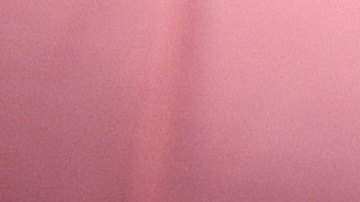 Los médicos aplicaron un arriesgado tratamiento con células madre sanguíneas.