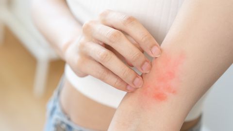 Alergia