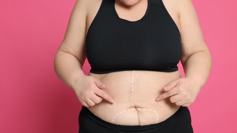 Obese,Woman,With,Marks,On,Body,Against,Pink,Background,,Closeup.