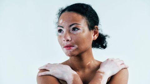 Vitiligo