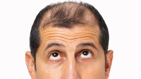Puede ser causada por una variedad de factores, incluidos los genéticos, hormonales y relacionados con el estilo de vida