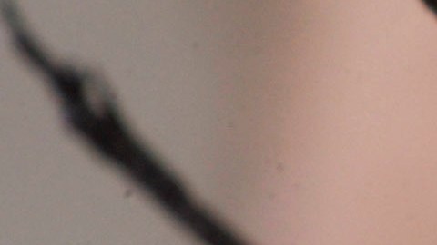 El joven se sometió a una operación para tratar de reparar su retina luego del hecho que ocurrió en mayo de 2022, pero su condición sigue deteriorándose.