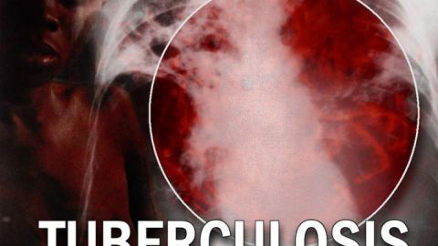 Tuberculosis enfermedad