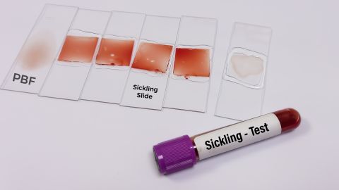 Anemia falciforme