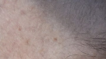 ¿Por qué Elon Musk tenía un ojo morado en su última aparición junto a Trump?