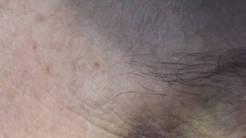 ¿Por qué Elon Musk tenía un ojo morado en su última aparición junto a Trump?
